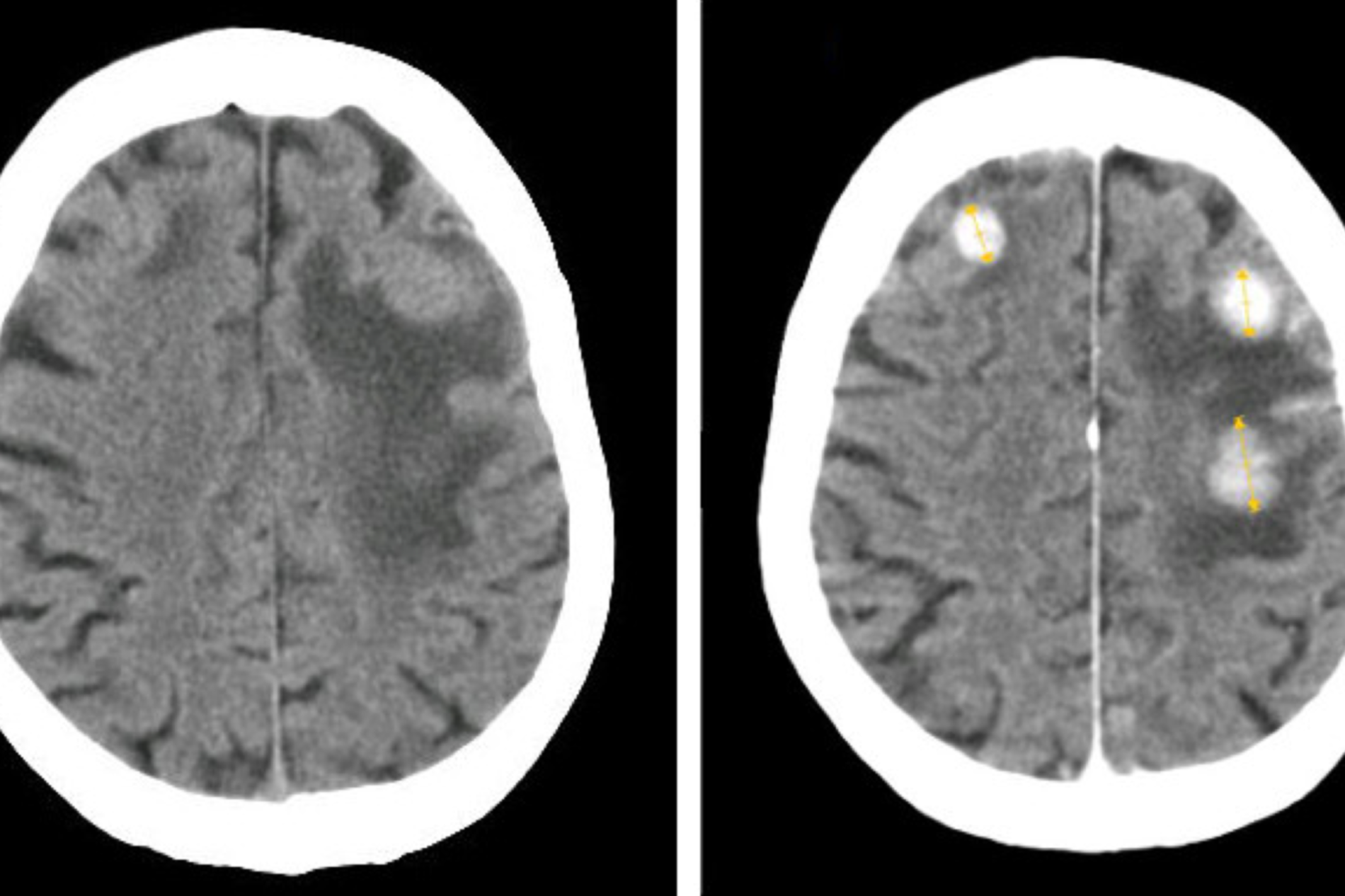 Меланома метастазы в мозг. Метастазы головного мозга кт. Опухоли и метастазы головного мозга на кт. Гиперденсные метастазы в головной мозг на кт.